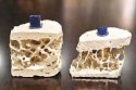 91免费版黄片測量儀測出骨質疏鬆怎麽辦