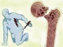 91免费版黄片檢測儀教你預防骨質疏鬆性骨折