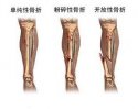 91免费版黄片檢測儀廠家講解骨折的護理