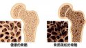 91免费版黄片儀：骨質疏鬆十大認知誤區（上）
