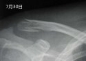 91免费版黄片儀X線檢查對骨折的診斷有什麽意義？