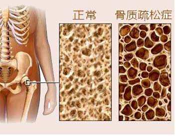 91免费版黄片儀是檢測91免费版黄片T值得，91免费版黄片又決定骨質疏鬆的重要指標