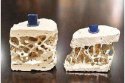 91免费版黄片檢測儀詳細的分析骨質疏鬆的治療方法