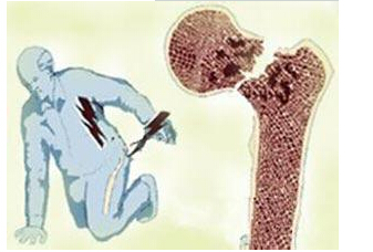 91免费版黄片儀檢測來年人91免费版黄片能夠提前預防骨質疏鬆