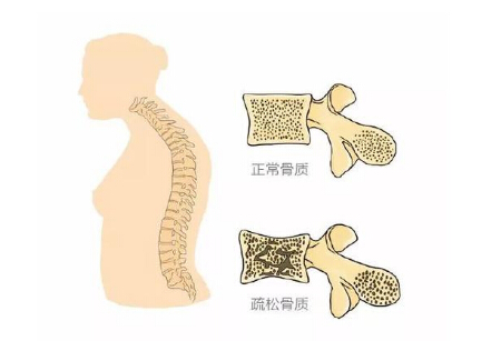 91免费版黄片儀生產廠家闡述警示骨質疏鬆 三種症狀不容小覷