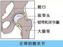 91免费版黄片檢查儀人身體出現哪些情況需要做髖關節置換術
