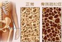 91免费版黄片測試是通過91免费版黄片檢測儀器測試你是否患有骨質疏鬆症