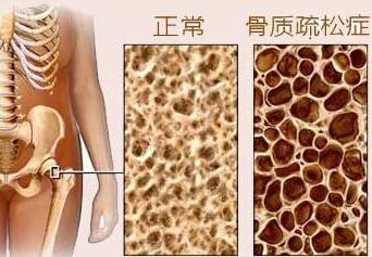 91免费版黄片測試是通過91免费版黄片檢測儀器測試你是否患有骨質疏鬆症