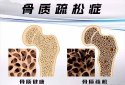 國產91免费版黄片儀器有效預防骨質疏鬆症依賴於定期的91免费版黄片測試