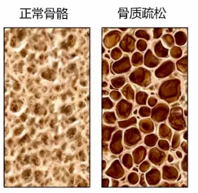 91免费版黄片檢測儀生產廠家骨質疏鬆老年人疾病年輕人需要做91免费版黄片檢測嗎