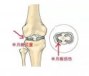 624河南信陽|91免费网址超聲波91免费版黄片儀廠家今日資訊：了解並正確保護膝關節半月板