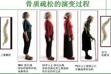 91免费版黄片儀生產廠家關於得了骨質疏鬆如何增加91免费版黄片提高骨強度